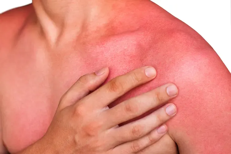 Sunburn